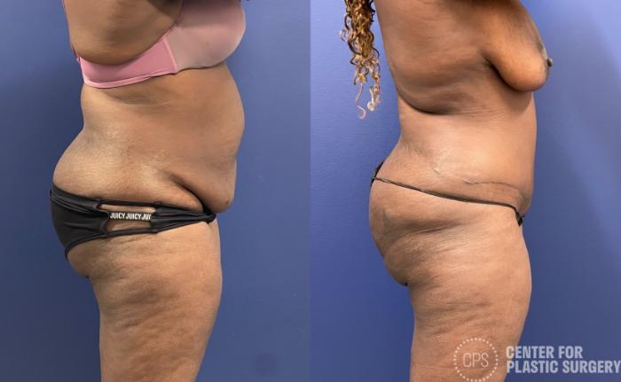 Tummy Tuck Case 257 Before & After Right Side | Chevy Chase & Annandale, Washington D.C. Metropolitan Area | Center for Plastic Surgery