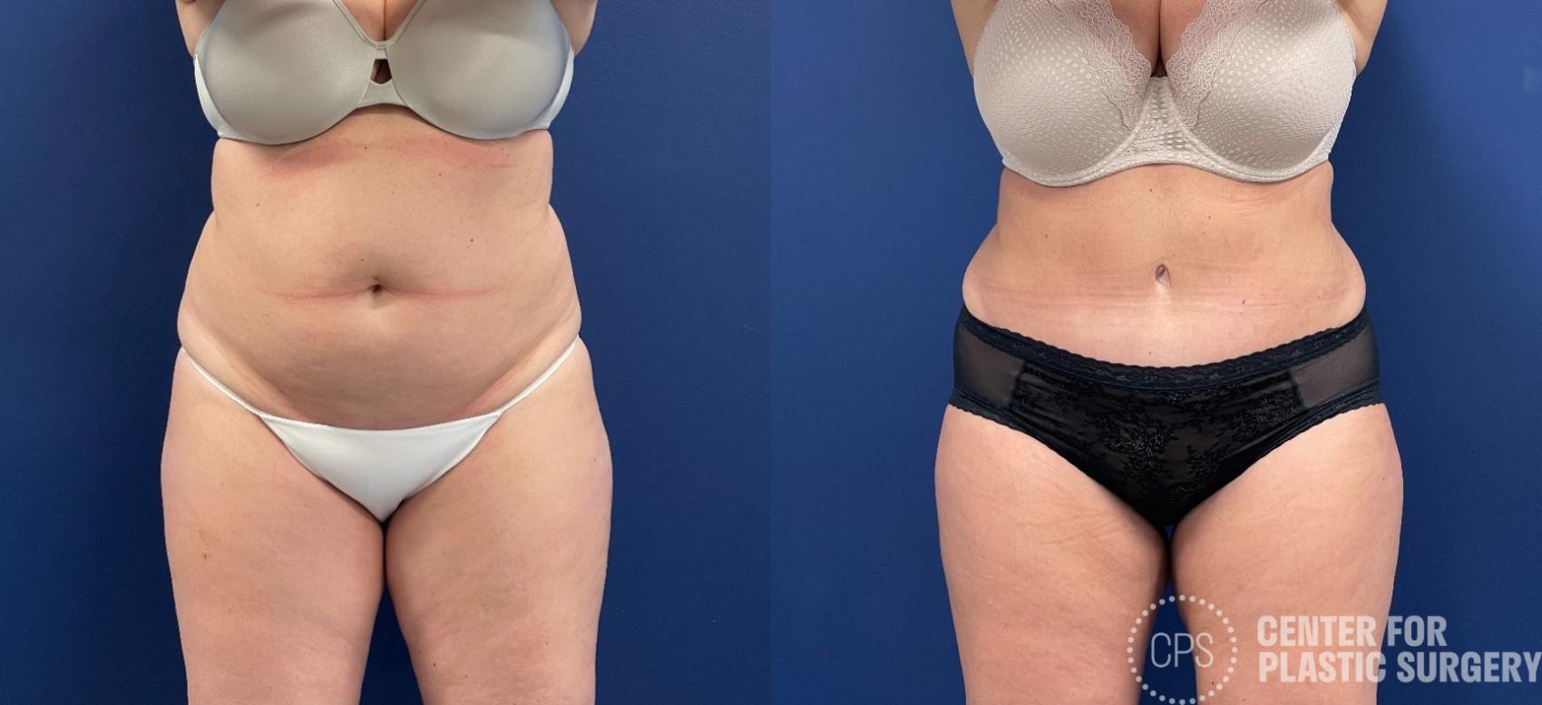 Tummy Tuck Case 258 Before & After Front | Chevy Chase & Annandale, Washington D.C. Metropolitan Area | Center for Plastic Surgery