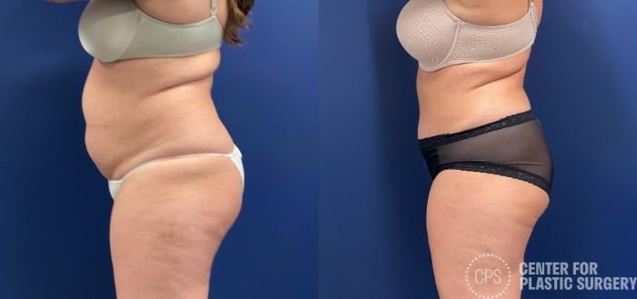 Tummy Tuck Case 258 Before & After Left Side | Chevy Chase & Annandale, Washington D.C. Metropolitan Area | Center for Plastic Surgery