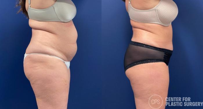 Tummy Tuck Case 258 Before & After Right Side | Chevy Chase & Annandale, Washington D.C. Metropolitan Area | Center for Plastic Surgery