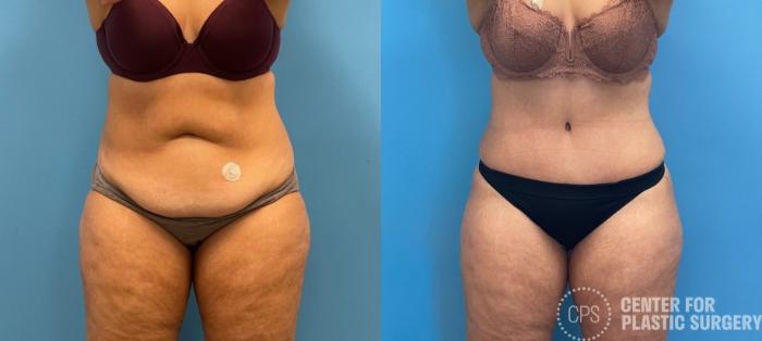 Tummy Tuck Case 259 Before & After Front | Chevy Chase & Annandale, Washington D.C. Metropolitan Area | Center for Plastic Surgery