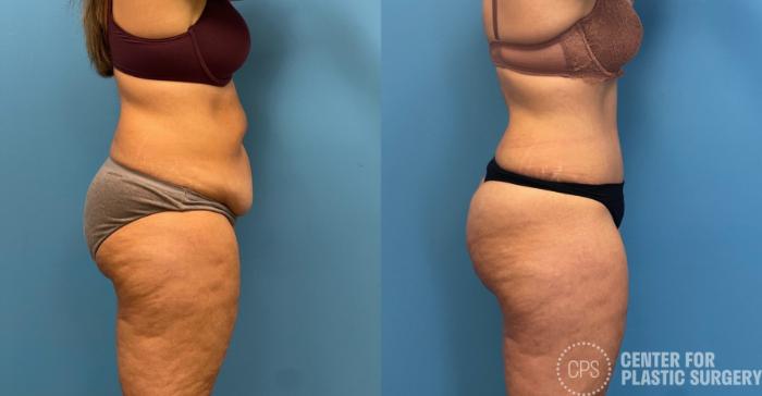 Tummy Tuck Case 259 Before & After Right Side | Chevy Chase & Annandale, Washington D.C. Metropolitan Area | Center for Plastic Surgery