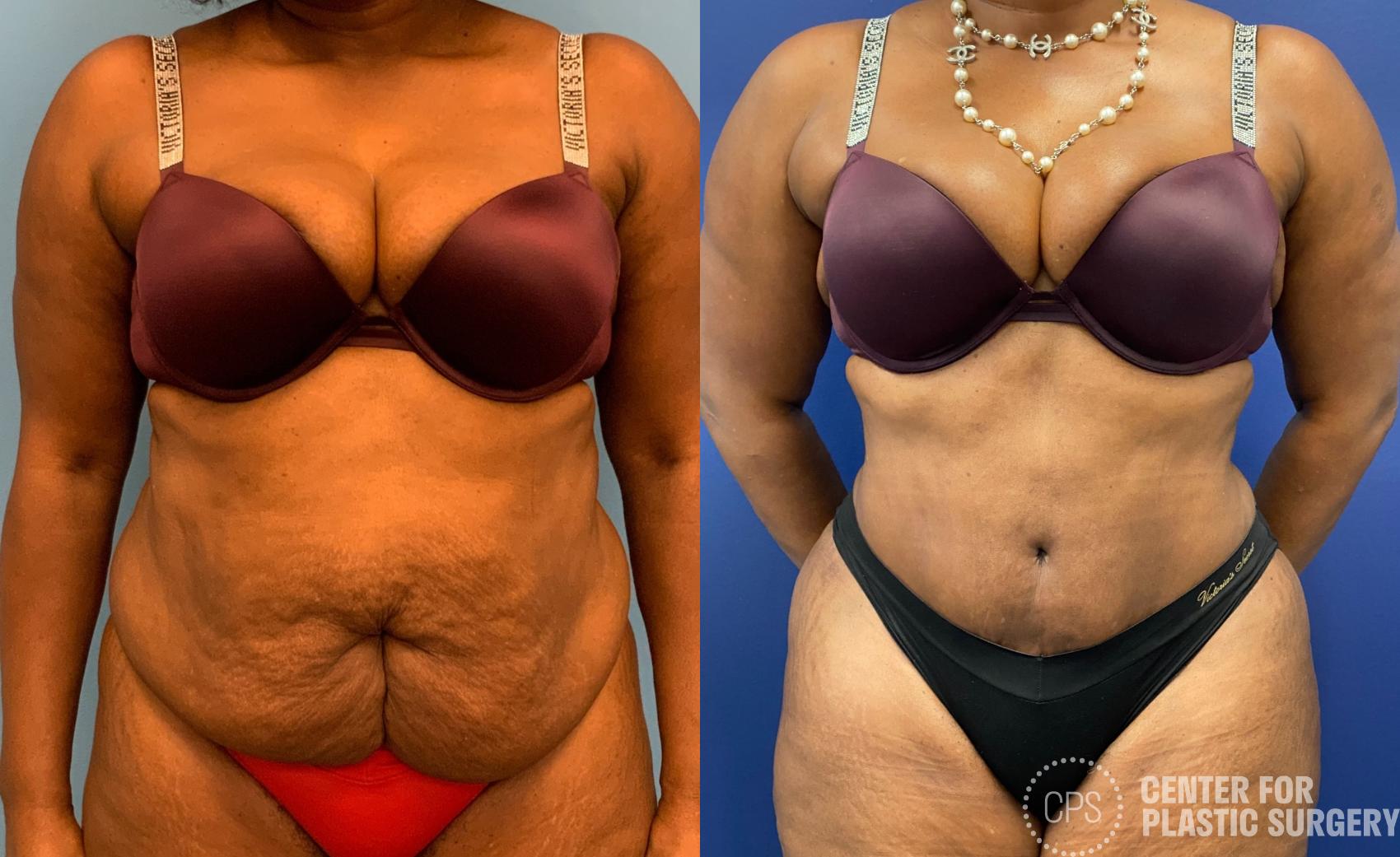 Plus Size Tummy Tuck Surgery Before & After Photo Gallery