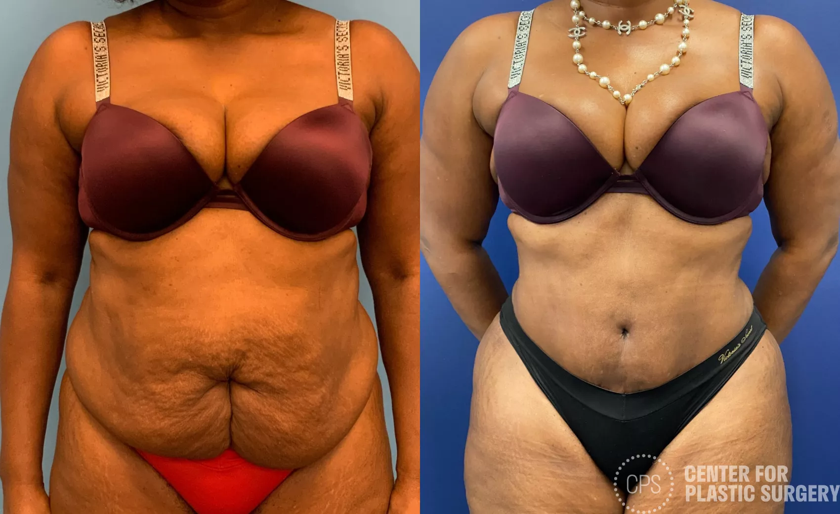 African American Tummy Tuck