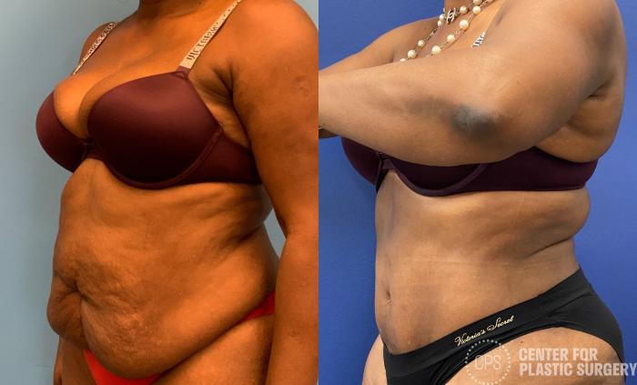 Liposuction Case 326 Before & After Left Oblique | Chevy Chase & Annandale, Washington D.C. Metropolitan Area | Center for Plastic Surgery