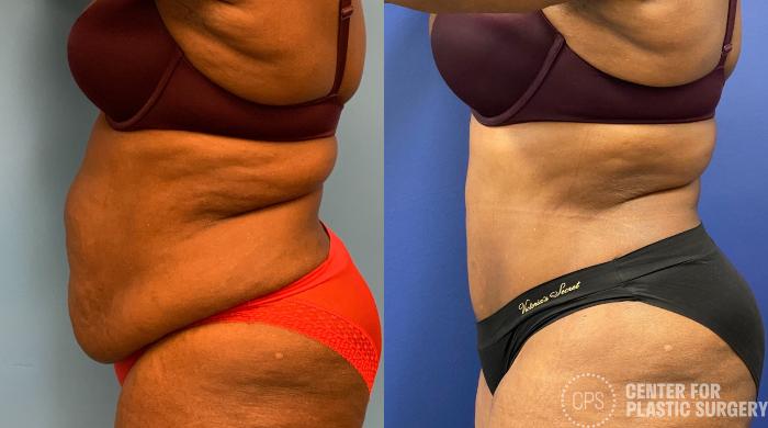 Tummy Tuck Case 326 Before & After Left Side | Chevy Chase & Annandale, Washington D.C. Metropolitan Area | Center for Plastic Surgery