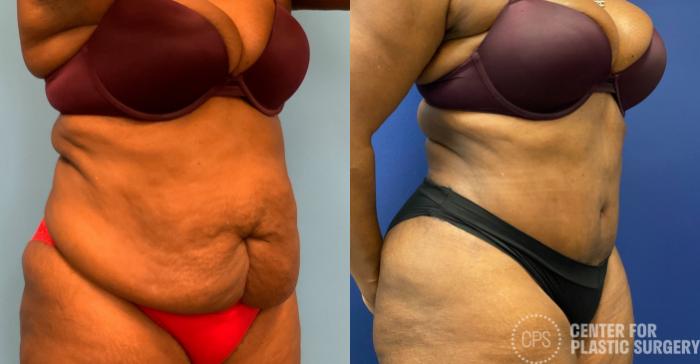 Liposuction Case 326 Before & After Right Oblique | Chevy Chase & Annandale, Washington D.C. Metropolitan Area | Center for Plastic Surgery