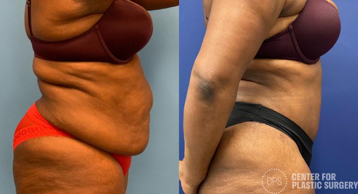 Tummy Tuck Case 326 Before & After Right Side | Chevy Chase & Annandale, Washington D.C. Metropolitan Area | Center for Plastic Surgery