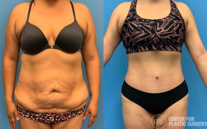 Tummy Tuck Case 327 Before & After Front | Chevy Chase & Annandale, Washington D.C. Metropolitan Area | Center for Plastic Surgery