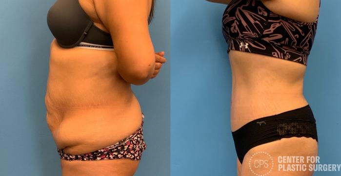 Tummy Tuck Case 327 Before & After Left Side | Chevy Chase & Annandale, Washington D.C. Metropolitan Area | Center for Plastic Surgery