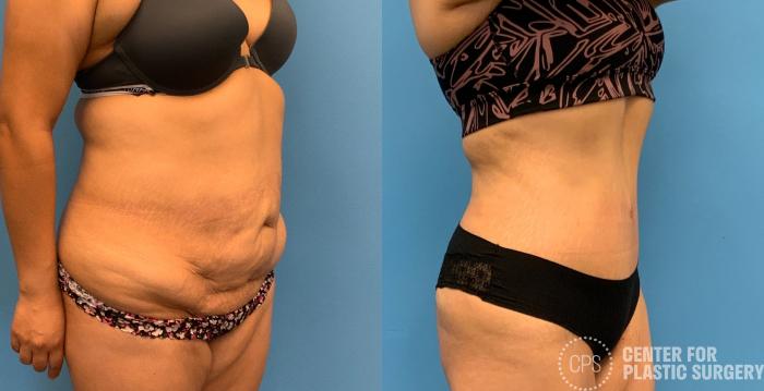 Tummy Tuck Case 327 Before & After Right Oblique | Chevy Chase & Annandale, Washington D.C. Metropolitan Area | Center for Plastic Surgery