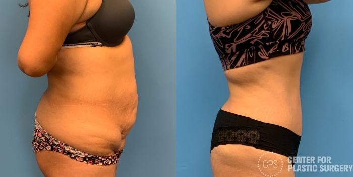 Tummy Tuck Case 327 Before & After Right Side | Chevy Chase & Annandale, Washington D.C. Metropolitan Area | Center for Plastic Surgery