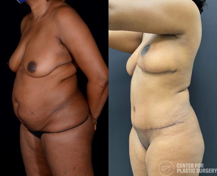 Tummy Tuck Case 336 Before & After Left Oblique | Chevy Chase & Annandale, Washington D.C. Metropolitan Area | Center for Plastic Surgery