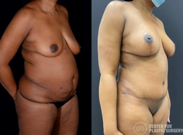 Mommy Makeover Case 336 Before & After Right Oblique | Chevy Chase & Annandale, Washington D.C. Metropolitan Area | Center for Plastic Surgery