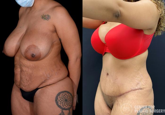 Liposuction Case 338 Before & After Right Oblique | Chevy Chase & Annandale, Washington D.C. Metropolitan Area | Center for Plastic Surgery