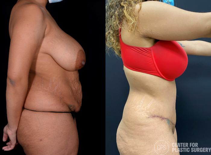 Tummy Tuck Case 338 Before & After Right Side | Chevy Chase & Annandale, Washington D.C. Metropolitan Area | Center for Plastic Surgery