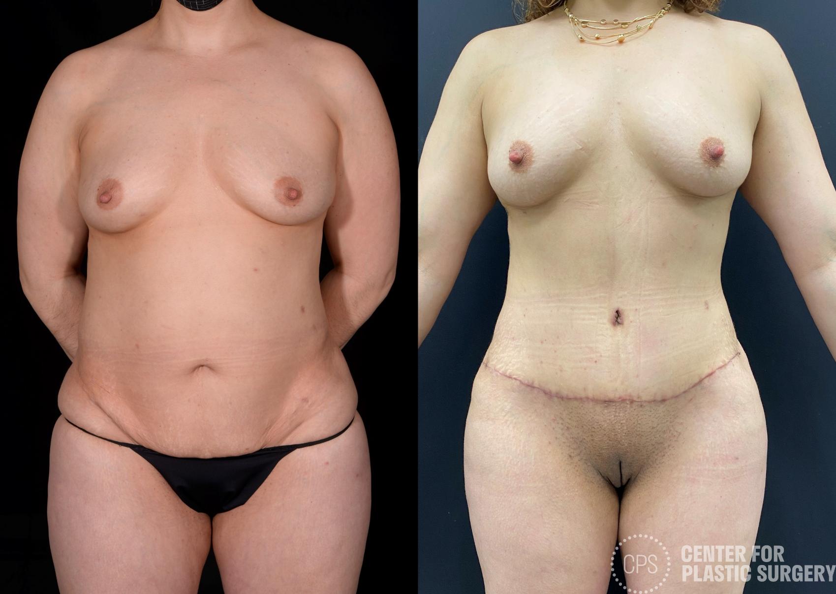 Tummy Tuck Case 339 Before & After Front | Chevy Chase & Annandale, Washington D.C. Metropolitan Area | Center for Plastic Surgery