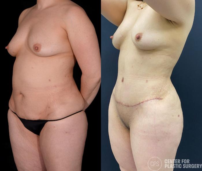 Liposuction Case 339 Before & After Left Oblique | Chevy Chase & Annandale, Washington D.C. Metropolitan Area | Center for Plastic Surgery