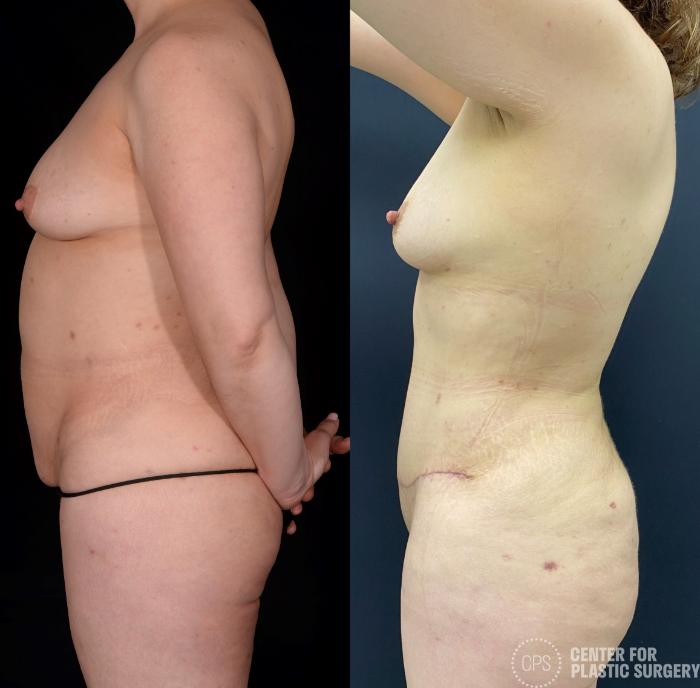 Tummy Tuck Case 339 Before & After Left Side | Chevy Chase & Annandale, Washington D.C. Metropolitan Area | Center for Plastic Surgery