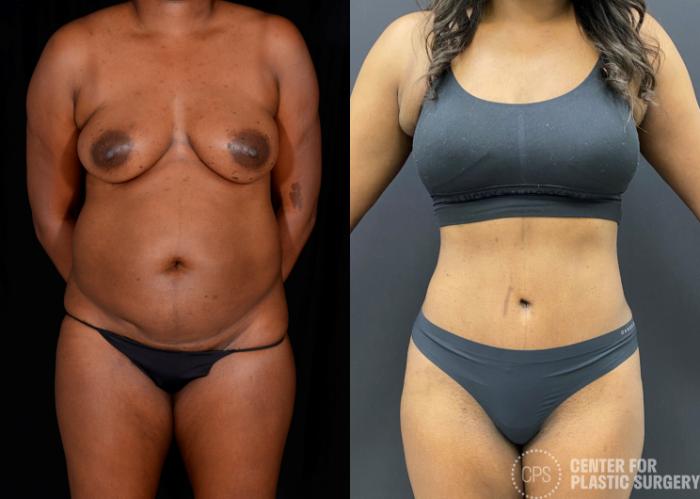 Tummy Tuck Case 340 Before & After Front | Chevy Chase & Annandale, Washington D.C. Metropolitan Area | Center for Plastic Surgery
