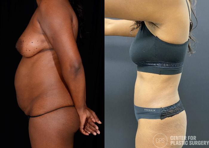 Tummy Tuck Case 340 Before & After Left Side | Chevy Chase & Annandale, Washington D.C. Metropolitan Area | Center for Plastic Surgery