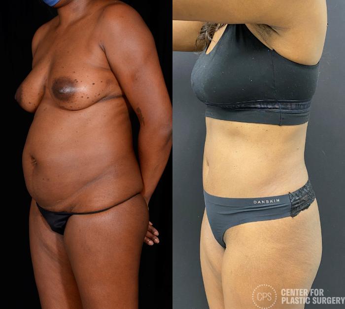 Tummy Tuck Case 340 Before & After Right Oblique | Chevy Chase & Annandale, Washington D.C. Metropolitan Area | Center for Plastic Surgery