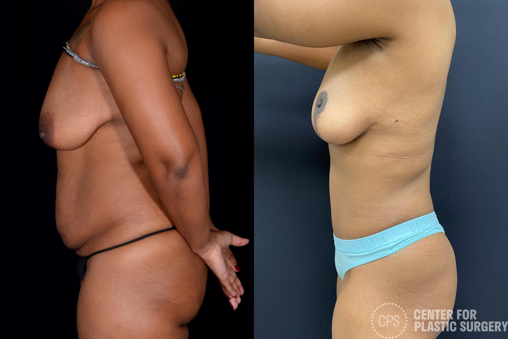 Tummy Tuck Case 341 Before & After Left Side | Chevy Chase & Annandale, Washington D.C. Metropolitan Area | Center for Plastic Surgery