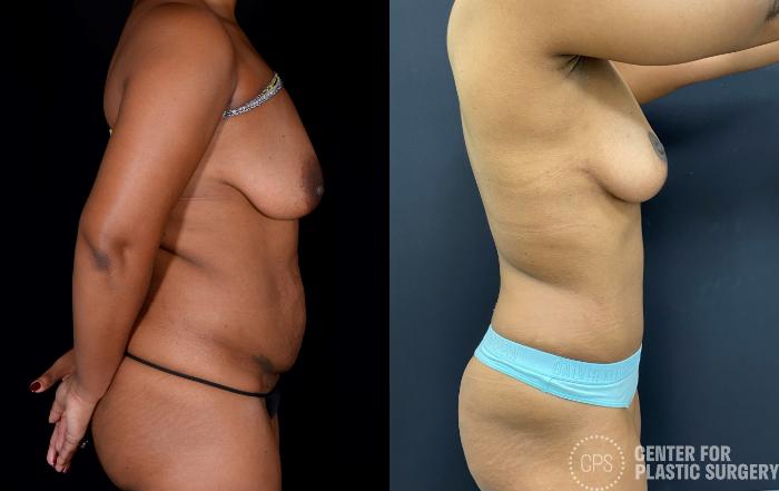 Tummy Tuck Case 341 Before & After Right Side | Chevy Chase & Annandale, Washington D.C. Metropolitan Area | Center for Plastic Surgery