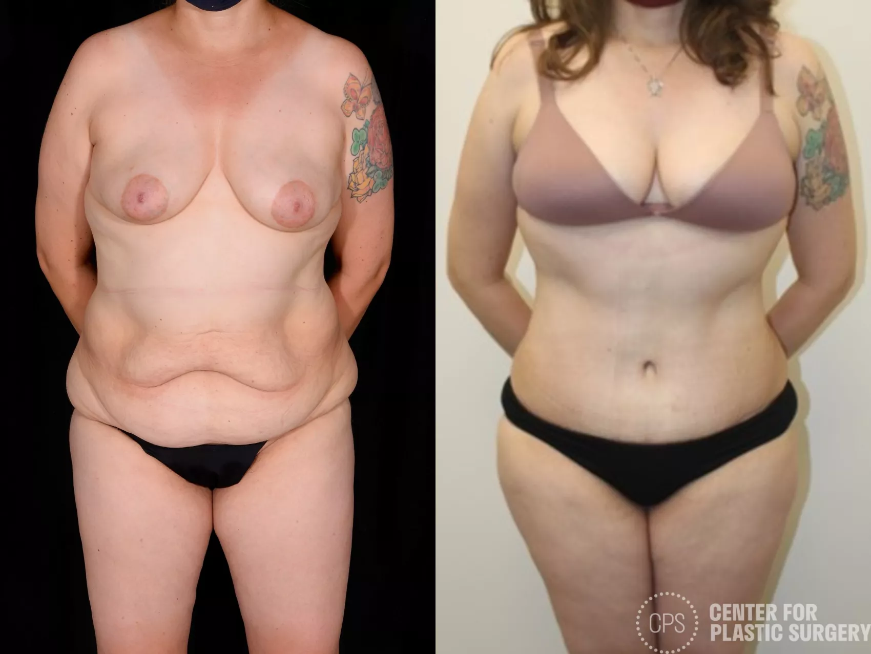 Tummy Tuck Before and After Photos Case 87