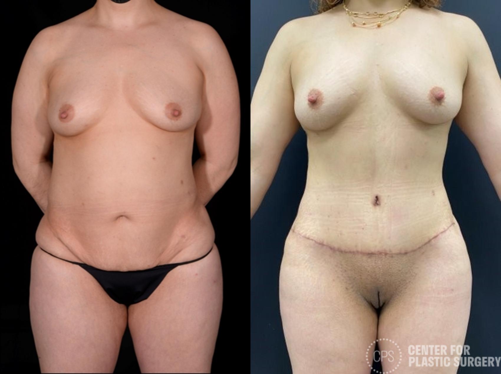 Tummy Tuck Case 382 Before & After Front | Annandale, Washington D.C. Metropolitan Area | Center for Plastic Surgery