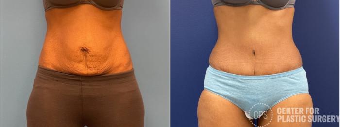 Liposuction Case 395 Before & After Front | Chevy Chase & Annandale, Washington D.C. Metropolitan Area | Center for Plastic Surgery