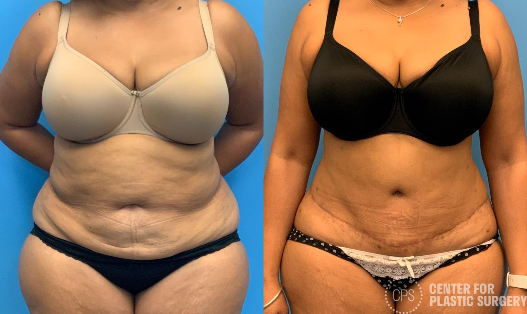 Tummy Tuck Case 407 Before & After Front | Chevy Chase & Annandale, Washington D.C. Metropolitan Area | Center for Plastic Surgery