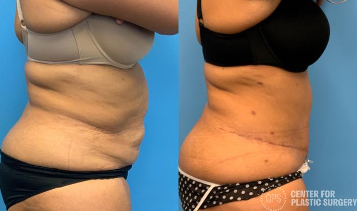 Tummy Tuck Case 407 Before & After Left Side | Chevy Chase & Annandale, Washington D.C. Metropolitan Area | Center for Plastic Surgery