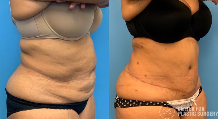 Tummy Tuck Case 407 Before & After Right Oblique | Chevy Chase & Annandale, Washington D.C. Metropolitan Area | Center for Plastic Surgery