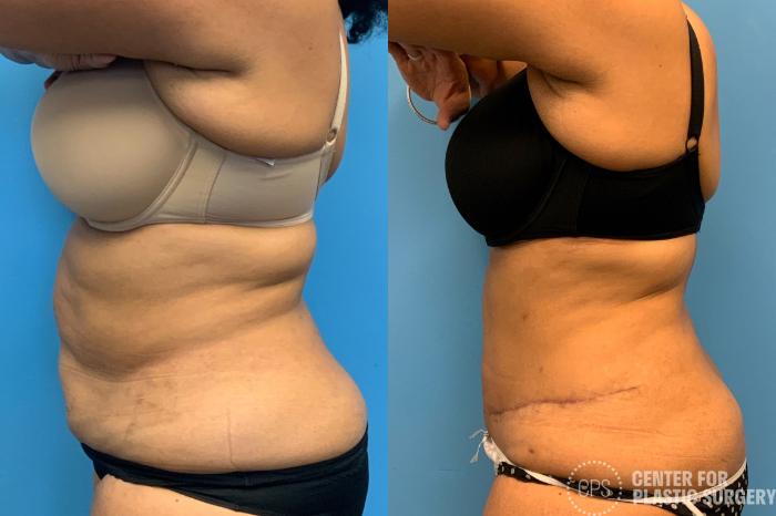 Tummy Tuck Case 407 Before & After Right Side | Chevy Chase & Annandale, Washington D.C. Metropolitan Area | Center for Plastic Surgery