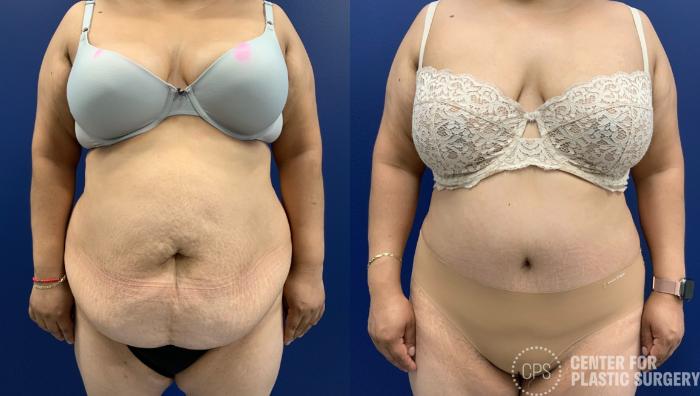 Tummy Tuck Case 410 Before & After Front | Chevy Chase & Annandale, Washington D.C. Metropolitan Area | Center for Plastic Surgery