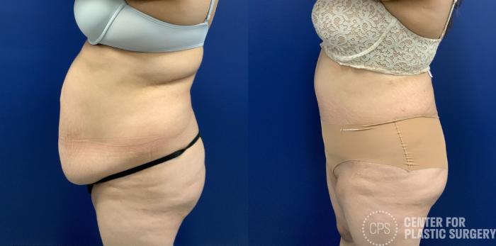 Tummy Tuck Case 410 Before & After Left Side | Chevy Chase & Annandale, Washington D.C. Metropolitan Area | Center for Plastic Surgery