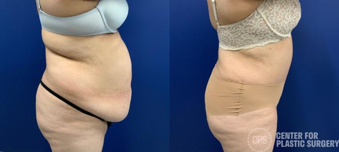 Tummy Tuck Case 410 Before & After Right Side | Chevy Chase & Annandale, Washington D.C. Metropolitan Area | Center for Plastic Surgery