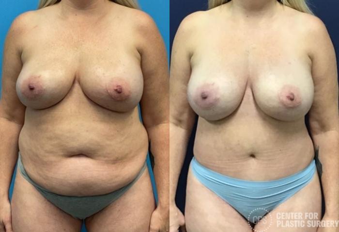 Tummy Tuck Case 415 Before & After Front | Chevy Chase & Annandale, Washington D.C. Metropolitan Area | Center for Plastic Surgery