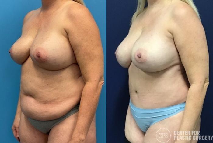 Liposuction Case 415 Before & After Left Oblique | Chevy Chase & Annandale, Washington D.C. Metropolitan Area | Center for Plastic Surgery
