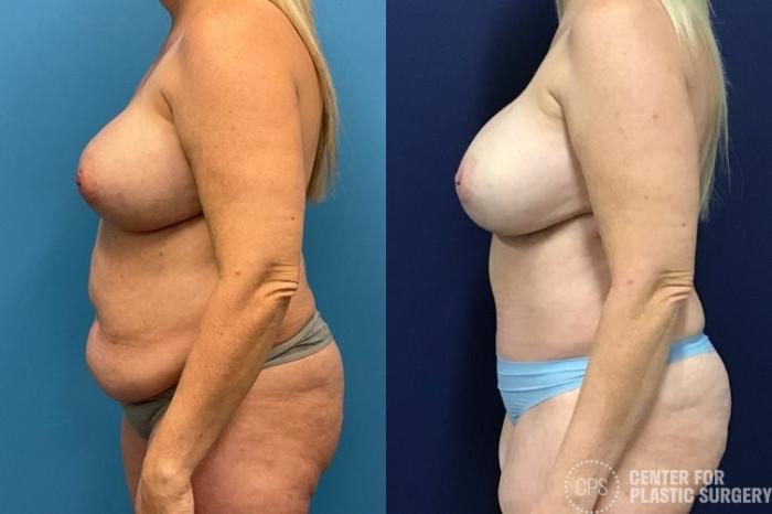 Tummy Tuck Case 415 Before & After Left Side | Chevy Chase & Annandale, Washington D.C. Metropolitan Area | Center for Plastic Surgery