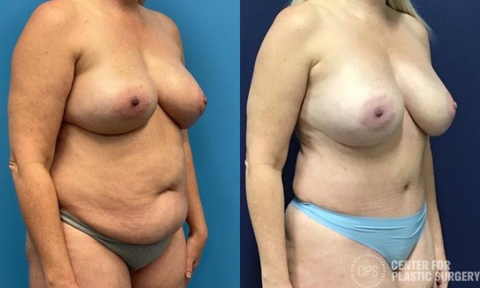Liposuction Case 415 Before & After Right Oblique | Chevy Chase & Annandale, Washington D.C. Metropolitan Area | Center for Plastic Surgery