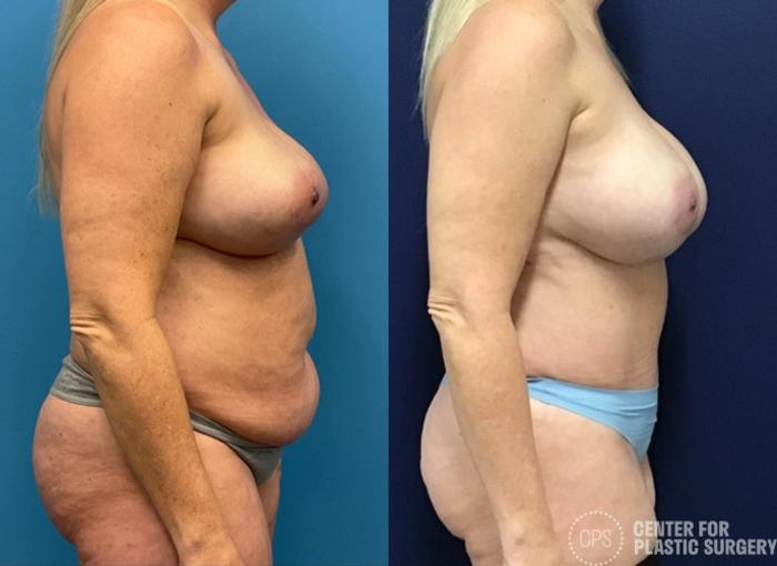 Tummy Tuck Case 415 Before & After Right Side | Chevy Chase & Annandale, Washington D.C. Metropolitan Area | Center for Plastic Surgery
