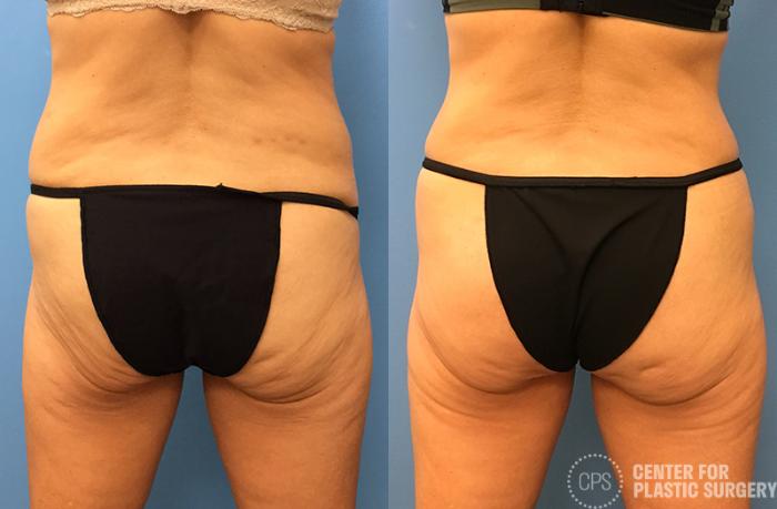 Liposuction Case 42 Before & After Back | Chevy Chase & Annandale, Washington D.C. Metropolitan Area | Center for Plastic Surgery
