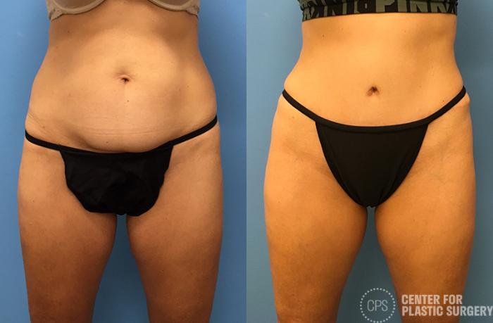 Tummy Tuck Case 42 Before & After Front | Chevy Chase & Annandale, Washington D.C. Metropolitan Area | Center for Plastic Surgery