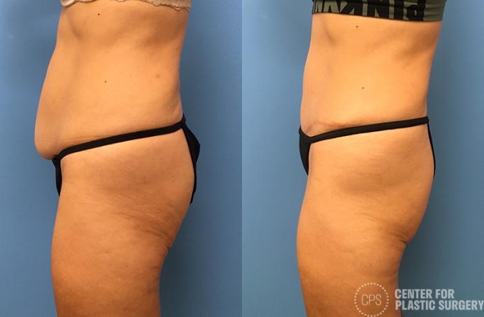 Liposuction Case 42 Before & After Left Side | Chevy Chase & Annandale, Washington D.C. Metropolitan Area | Center for Plastic Surgery