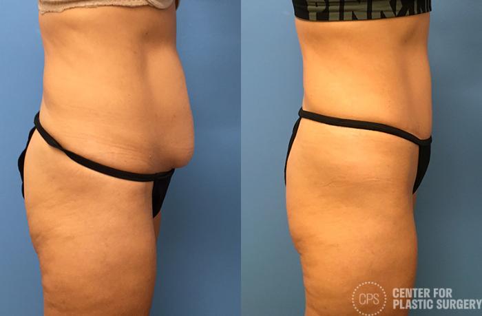 Liposuction Case 42 Before & After Right Side | Chevy Chase & Annandale, Washington D.C. Metropolitan Area | Center for Plastic Surgery