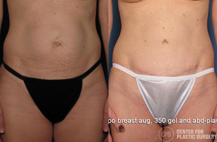 Tummy Tuck Case 43 Before & After Front | Chevy Chase & Annandale, Washington D.C. Metropolitan Area | Center for Plastic Surgery