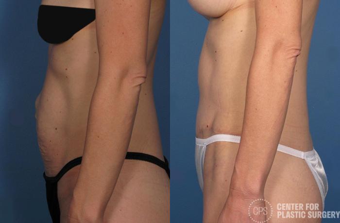 Tummy Tuck Case 43 Before & After Left Side | Chevy Chase & Annandale, Washington D.C. Metropolitan Area | Center for Plastic Surgery