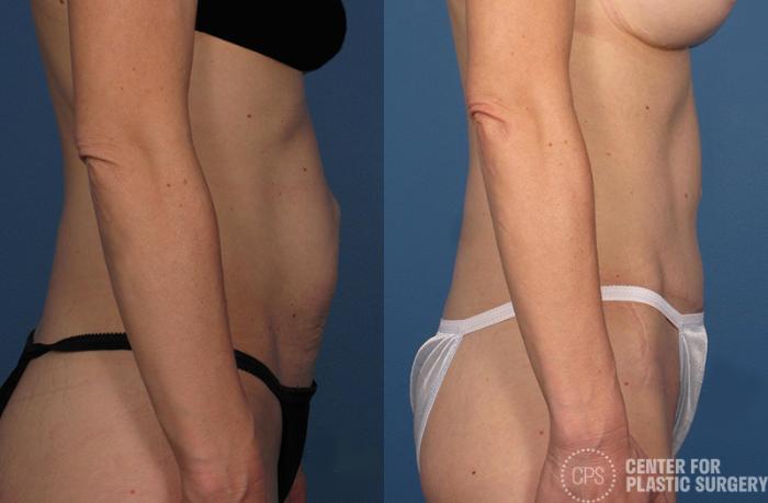 Tummy Tuck Case 43 Before & After Right Side | Chevy Chase & Annandale, Washington D.C. Metropolitan Area | Center for Plastic Surgery